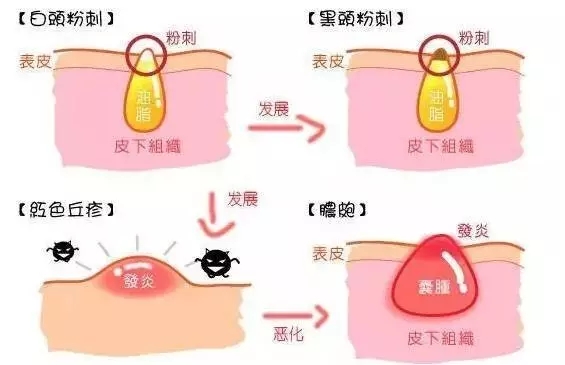 闭口,痘痘傻傻分不清?今天就来彻底解决! 闭口 612 × 408  0kb