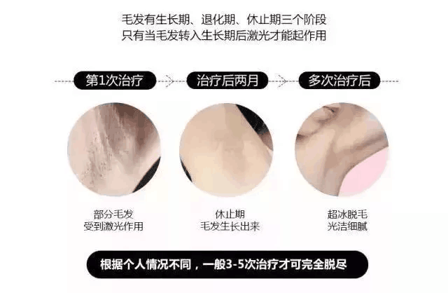 脱毛的原理_冰点脱毛的原理是什么