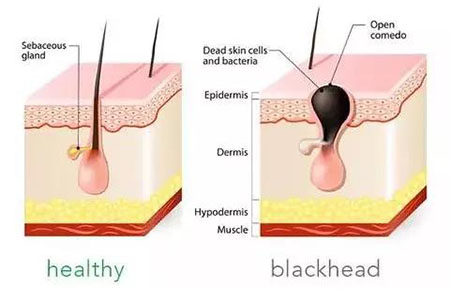 黑头总是去不掉？这可能是 全 有效的去黑头指南了！
