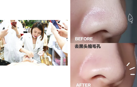 如何去黑头？为什么要定期做去黑头管理？VN给你好的答案