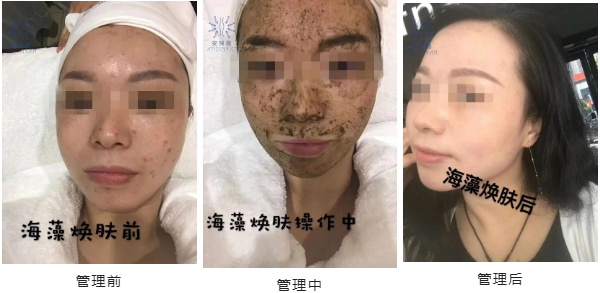 安锦颜：从“痘肌”到“婴儿肌”，海藻焕肤做了啥？